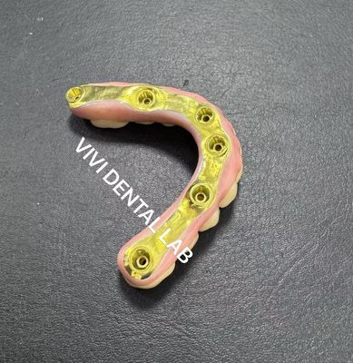 チタンバーのサポートとフルジルコニアブリッジ 中国歯科ラボ