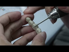 メタルセラミックブリッジ