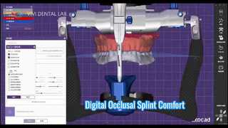 デジタル咬合スプリントの正確な快適性